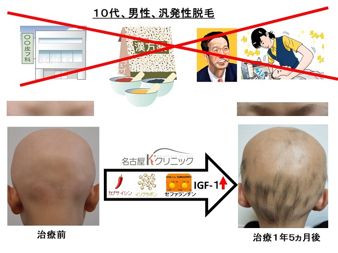 円形脱毛症　病院